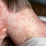 Florida alerta de brotes de sarampión en universidades ante récord del virus en EE.UU.