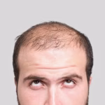 Caída del cabello: mitos, causas médicas y cuándo acudir al especialista para un tratamiento efectivo