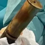 Extraen un proyectil de la Primera Guerra Mundial del recto de un joven