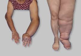 Día Internacional del Linfedema - Noticias de hoy en República Dominicana | De Último Minuto